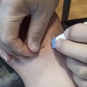 fisioterapia invasiva